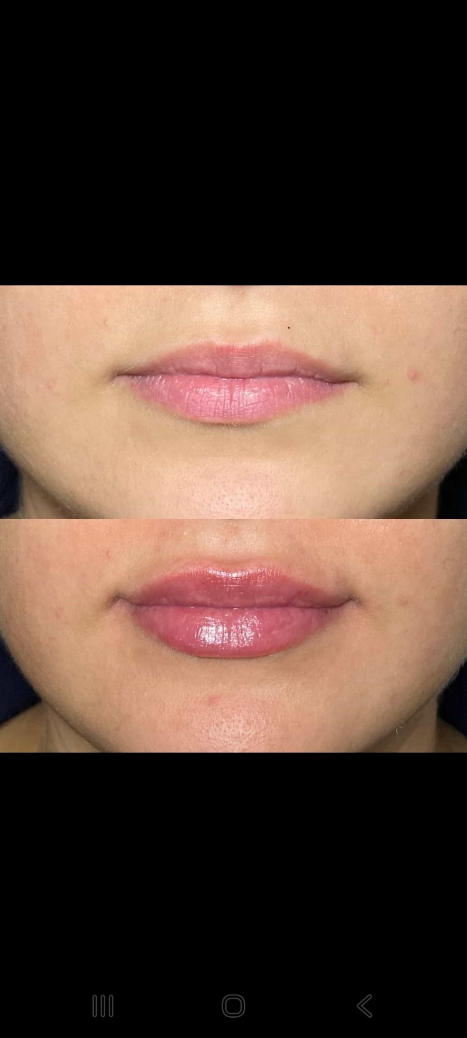 Dermal Fillers